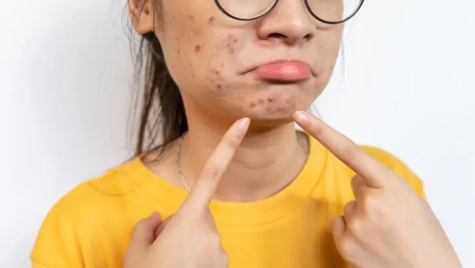 얼굴 여드름 손으로 짜서 죽은 소녀, 왜?